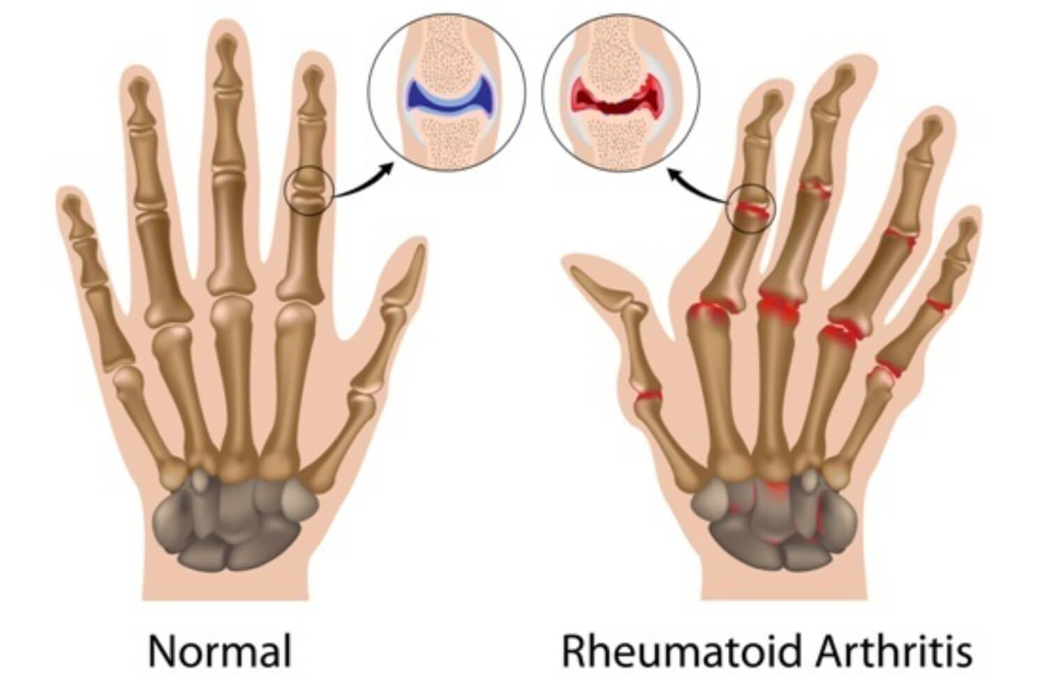 Rheumatoid Arthritis