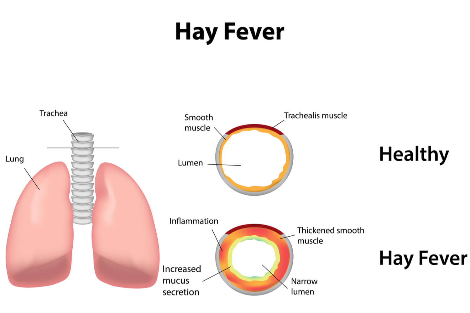 Babies Prone to Hay Fever