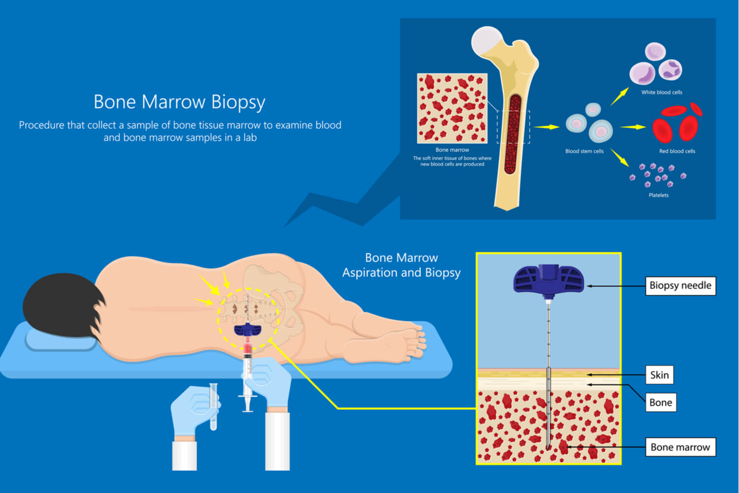 Bone Marrow Harvest