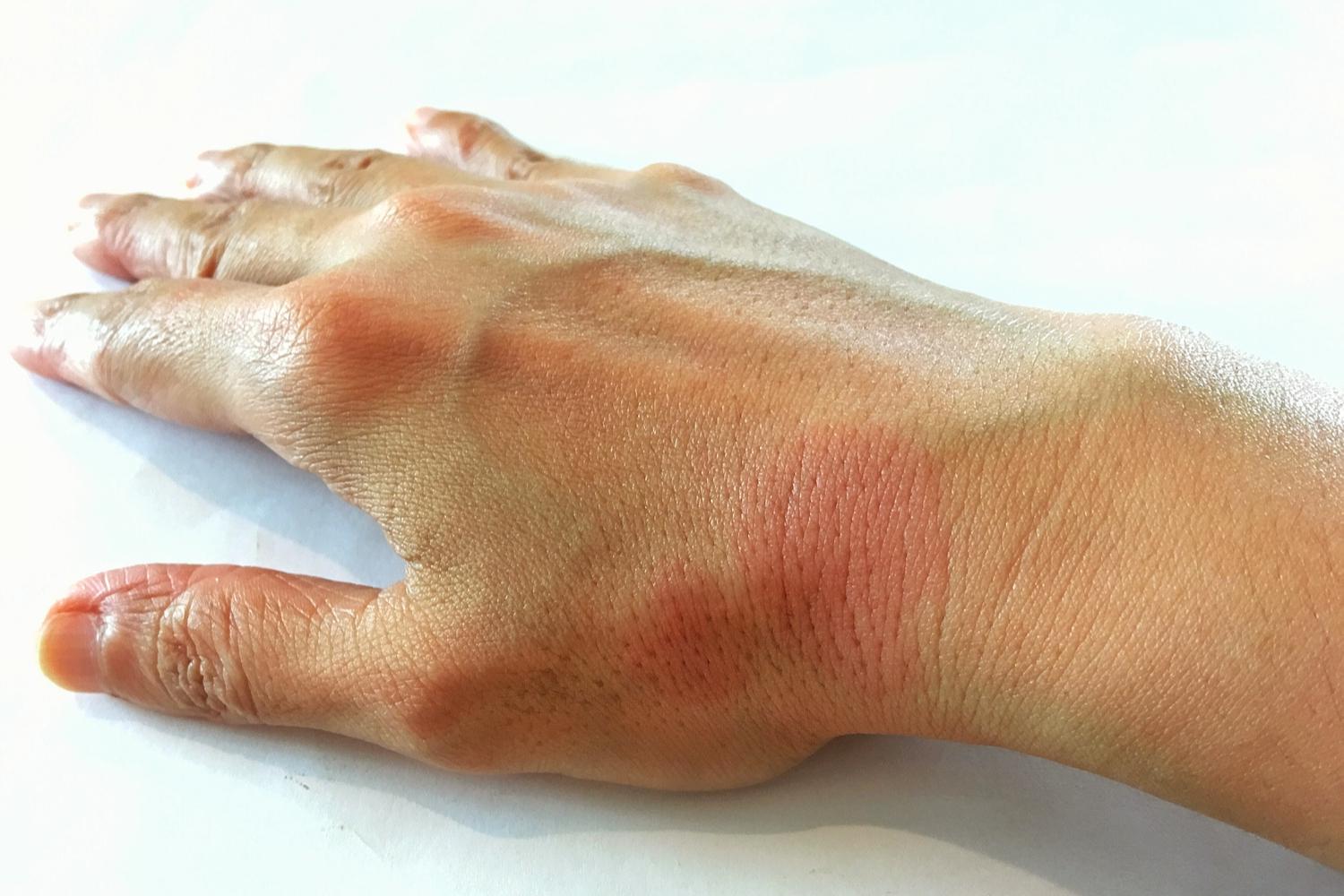 an a Lupus Patient Have a Successful Pregnancy