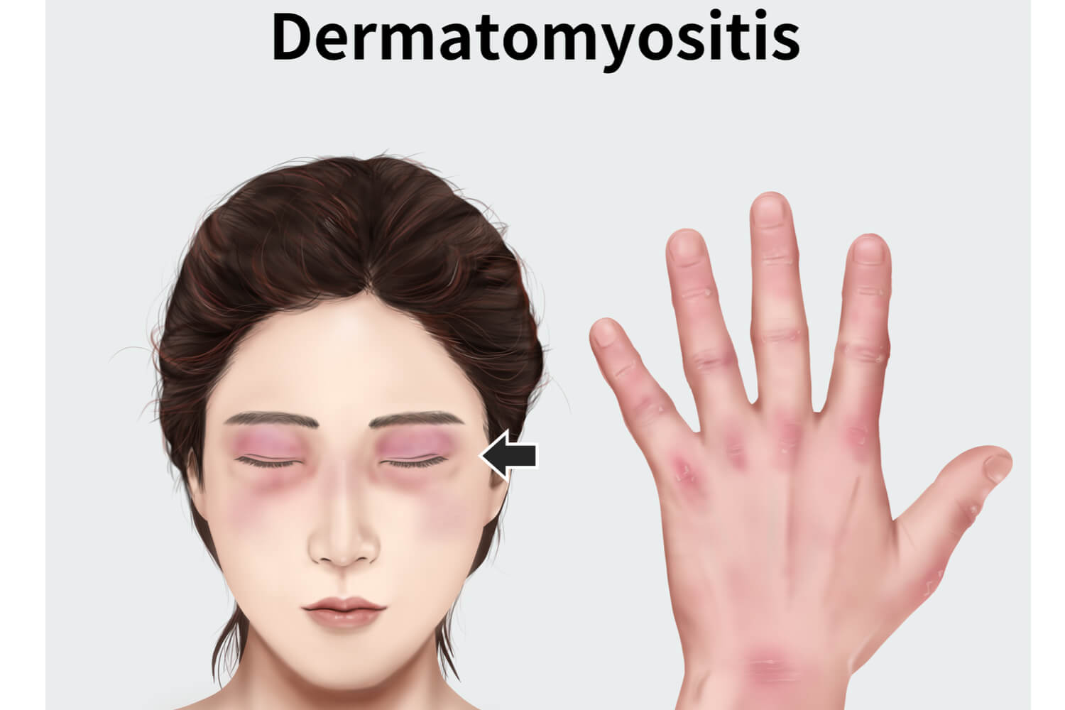 Causes of Juvenile Dermatomyositis