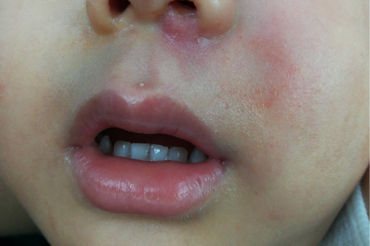 Signs And Symptoms of Wiskott-Aldrich Syndrome