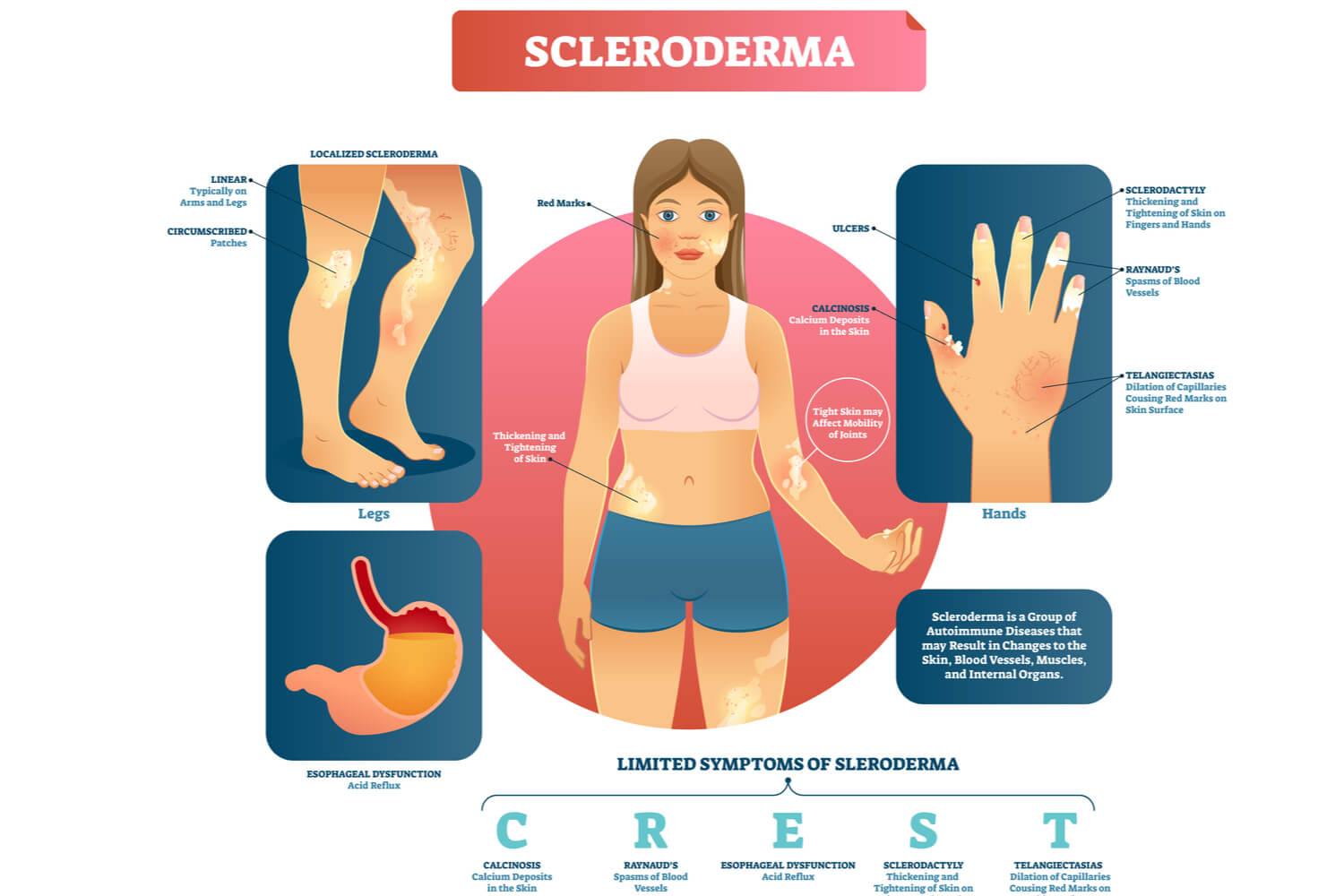 Signs and Symptoms of Pediatric Scleroderma