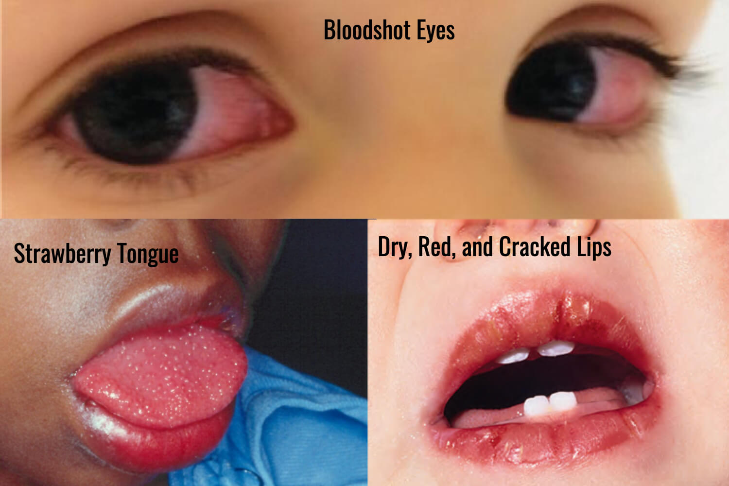Symptoms of Kawasaki Disease