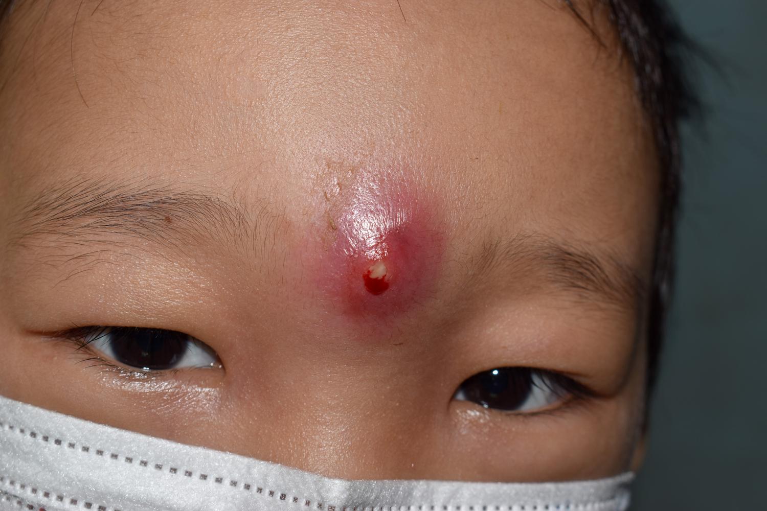 Who is at Risk For Developing Chronic Granulomatous Disease