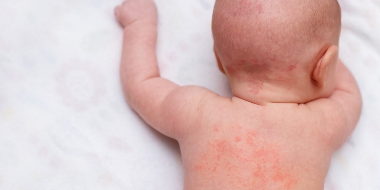 Wiskott – Aldrich Syndrome : Signs, Diagnosis And Treatment