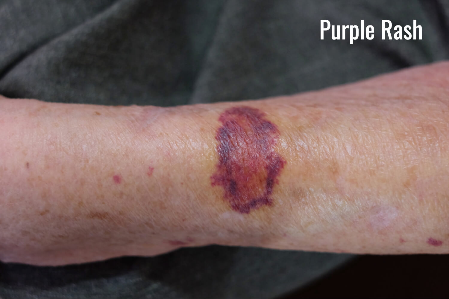 purple rash